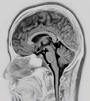 脳画像診断