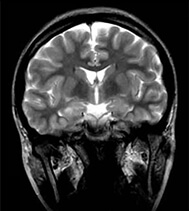 MRIでわかる脳の枝ぶり